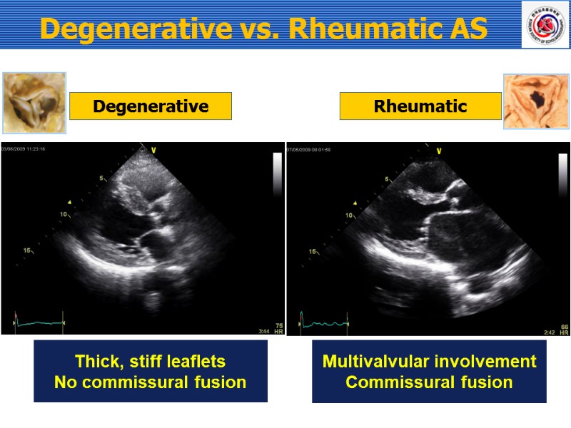 Degenerative vs. Rheumatic AS Thick, stiff leaflets No commissural fusion Degenerative Rheumatic Multivalvular involvement
